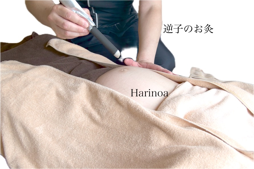 逆子の妊婦さんのお腹への棒灸